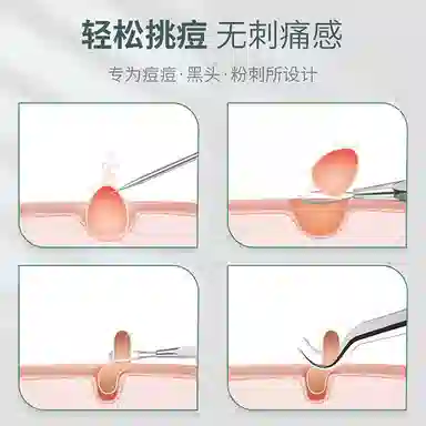 悦语 不锈钢粉刺针组合 黑头细胞夹