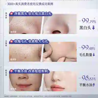 儒意 紫苏清洁泥膜 控油祛痘淡化痘印去黑头粉刺闭口收缩毛孔水杨酸深层清洁面部涂抹面膜 多种肤质