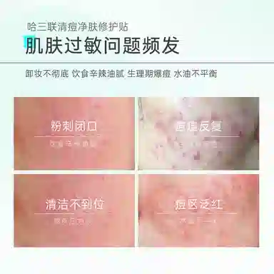 哈三联 清痘净肤修护贴