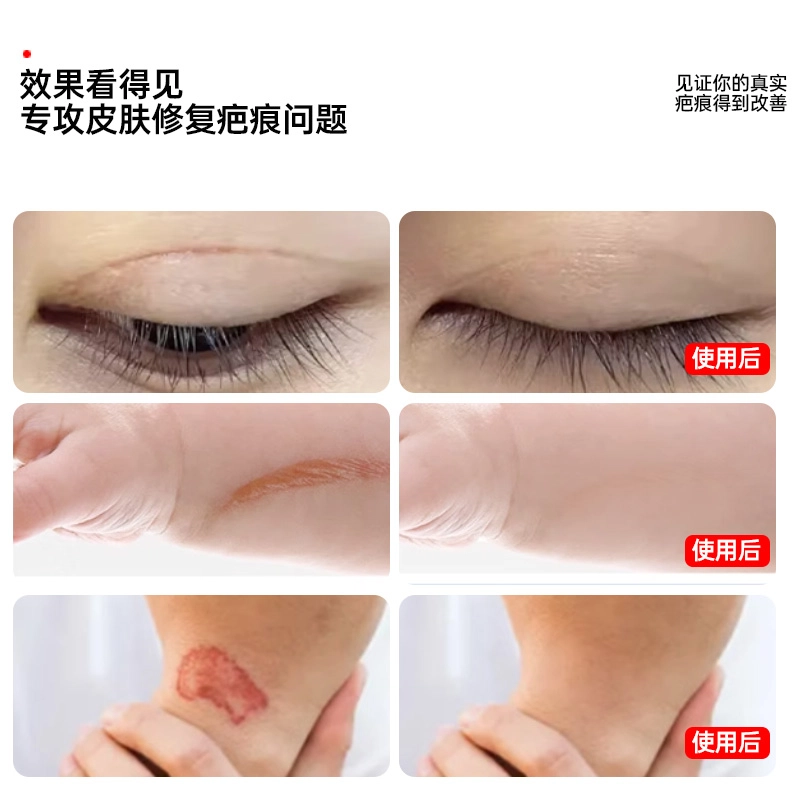 界面 医疗疤痕修复膏 剖腹产烫伤疤膏术后医用硅酮凝胶敷料增生凝胶