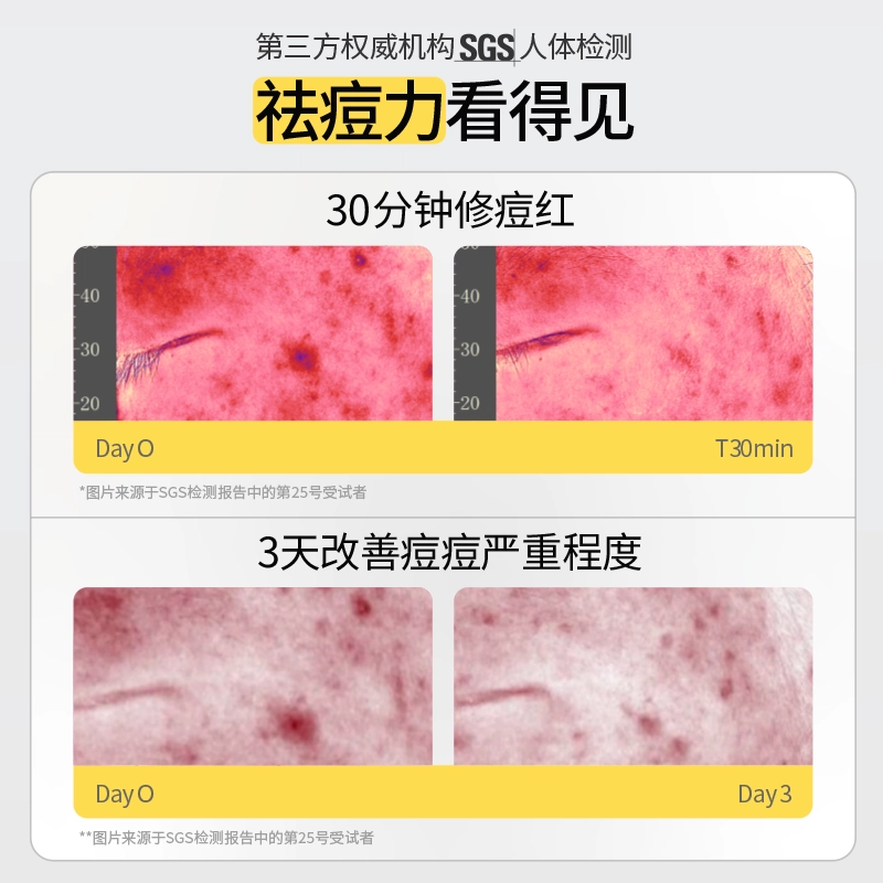 羽素 胶态硫祛痘精华Ⅲ 大灯泡祛痘精华两只装男女通用洗卸合一洁面乳温和护肤  保湿修护控油祛痘舒缓 油痘肌痘痘肌
