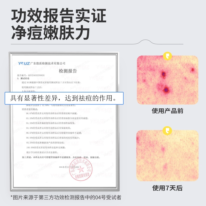 羽素 身体净痘嫩肤沐浴露 祛前胸背后痘