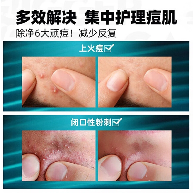 左颜右色 小绿罐祛痘膏水杨酸 凝胶男士 深层清洁祛痘舒缓淡痘印维稳祛粉刺 祛痘膏/洗面奶/精华液/面膜护肤品套装