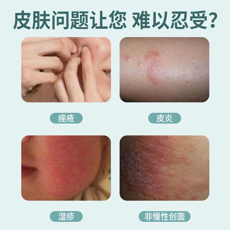 特一 选必治皮肤护理软膏 痤疮皮炎湿疹痘痘止痒过敏红点