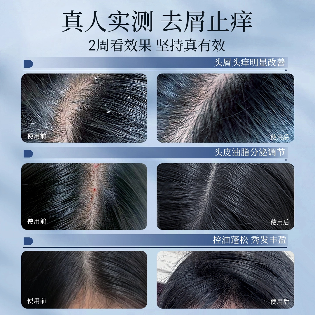 青幽堂去屑护发套装 去屑护发控油