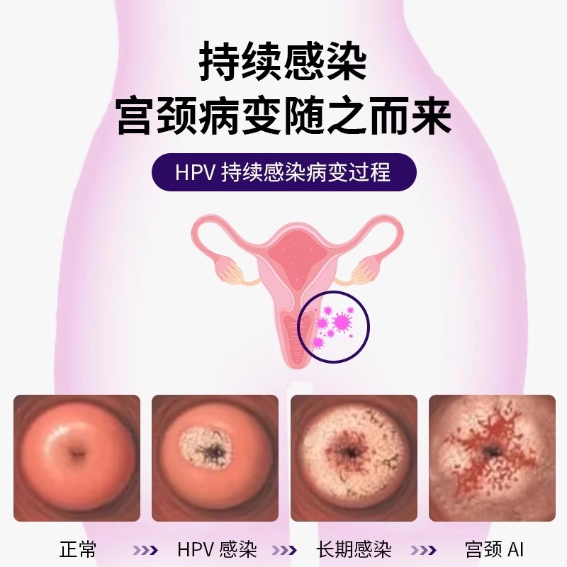 HPV hpv