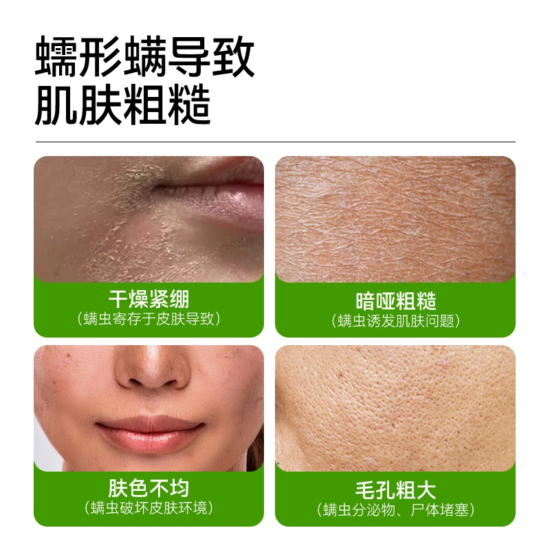 满婷皂 除螨抑螨沐浴香皂 洗面奶洁面精油皂 全身深层清洁油痘肥皂 保湿控油多效合一不紧绷 非硫磺不刺激