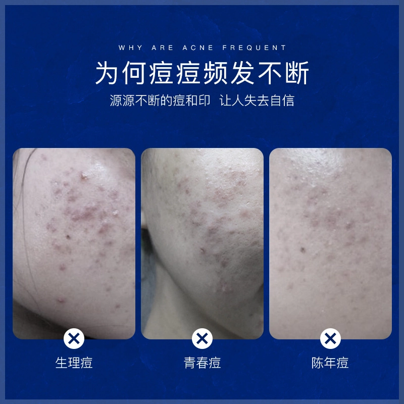 色娜娜  清爽滋润祛痘膏 保湿补水 中性肌