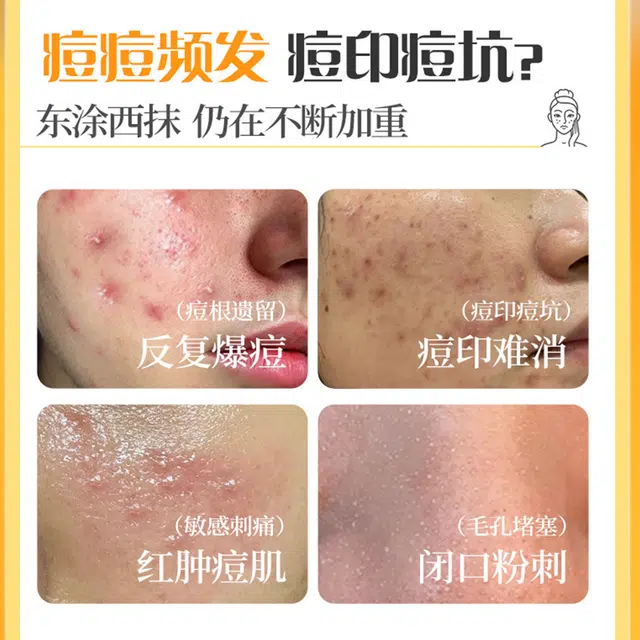 片仔癀 清痘护肤套装 淡痘印 修复去痘红肿