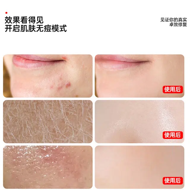 界面 去粉刺黑头壬二酸精华液水杨酸淡化痘印细致毛孔霜改善闭口 护肤 祛痘