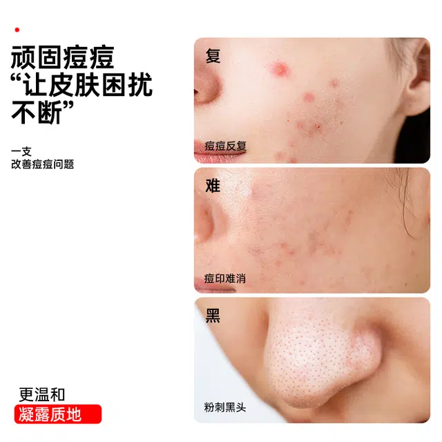 界面 去粉刺黑头壬二酸精华液水杨酸淡化痘印细致毛孔霜改善闭口 护肤 祛痘
