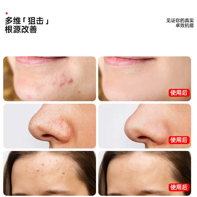 界面 去粉刺黑头壬二酸精华液水杨酸淡化痘印细致毛孔霜改善闭口 护肤 祛痘