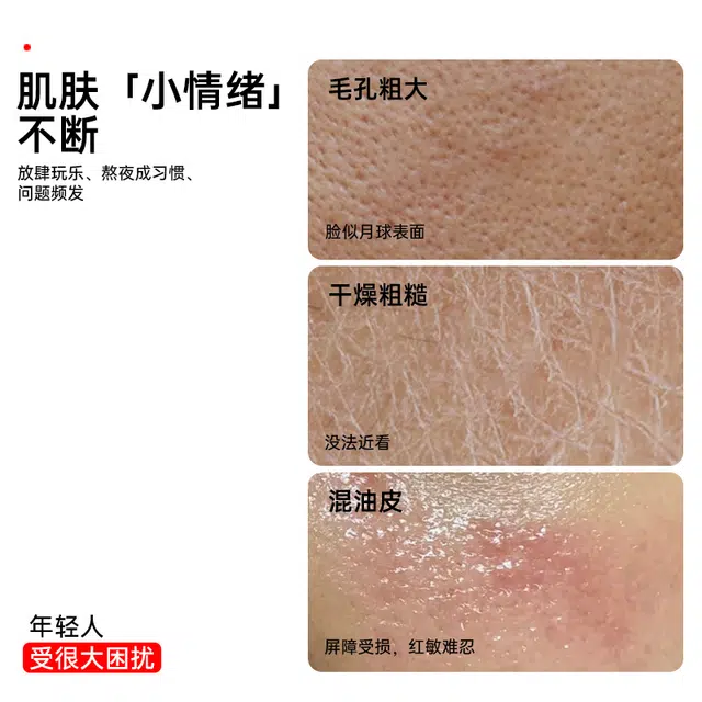 界面 去粉刺黑头壬二酸精华液水杨酸淡化痘印细致毛孔霜改善闭口 护肤 祛痘