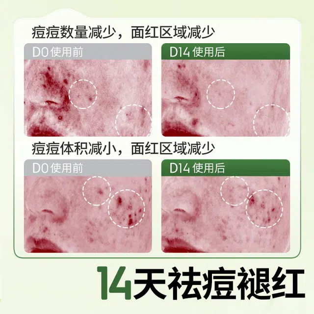 植物妈妈 泡泡祛痘洗面奶 清洁 油性肤质混合肌中性肌痘痘肌油痘肌