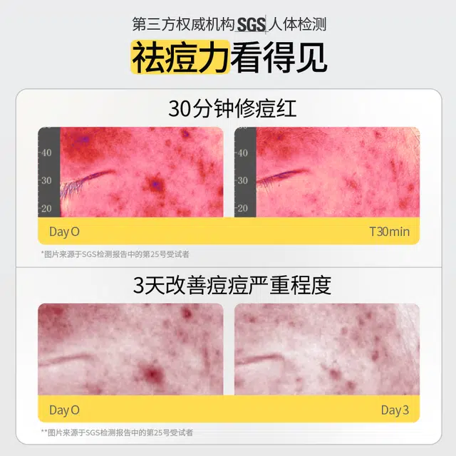 羽素 胶态硫祛痘精华Ⅲ 大灯泡祛痘精华两只装男女通用洗卸合一洁面乳温和护肤  保湿修护控油祛痘舒缓 油痘肌痘痘肌