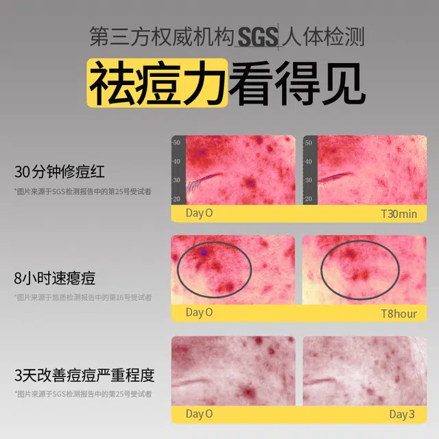 羽素 男士祛痘控油大灯泡精华全新第三代升级 击退红肿痘 青春痘 熬夜痘  保湿修护祛痘舒缓 油痘肌混合型肤质