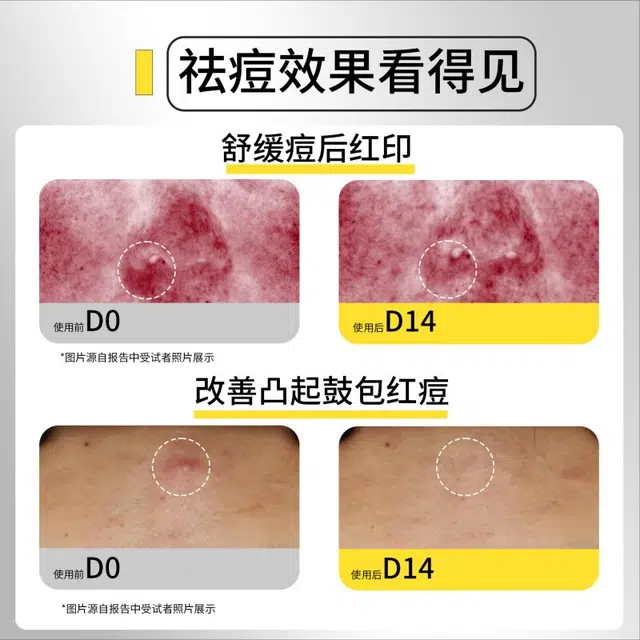 浣颜 祛痘系列 凝胶面膜护肤组合 舒缓保湿清爽
