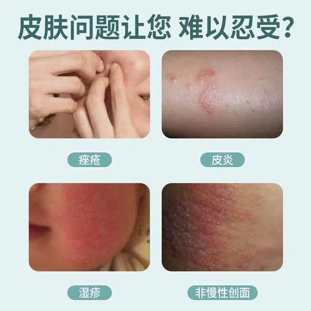 特一 选必治皮肤护理软膏 痤疮皮炎湿疹痘痘止痒过敏红点