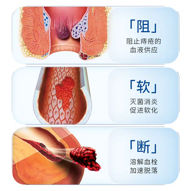 内廷上用同仁堂 医用凝胶痔疮敷料 内外混合消肉球消肿