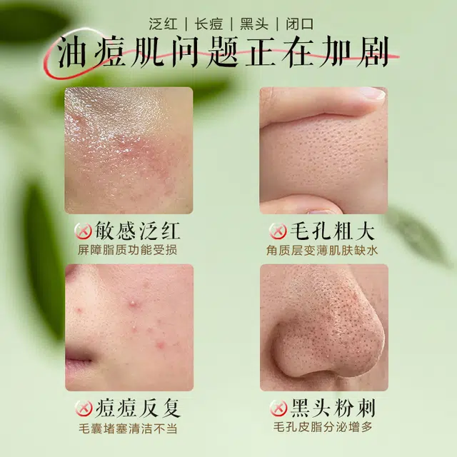 植祛小绿瓶祛痘精华液 修护清爽补水