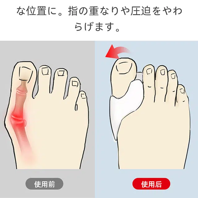 悦语 拇指外翻分扯 大单孔硅胶透气防磨脚趾矫正器