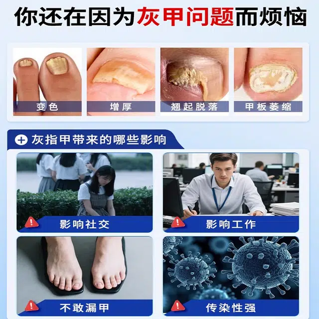 修正 医用灰指甲/甲沟炎专用抑菌液正品医用敷料