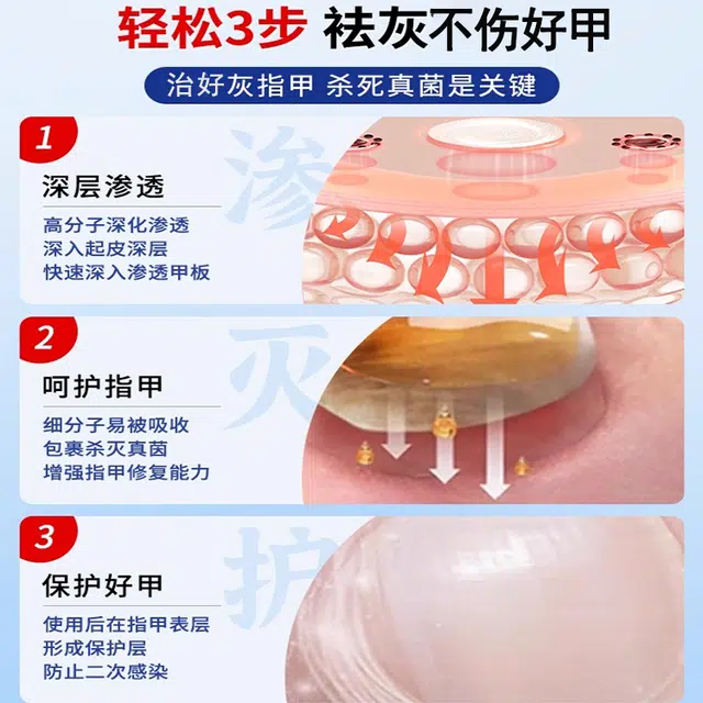 修正 医用灰指甲/甲沟炎专用抑菌液正品医用敷料