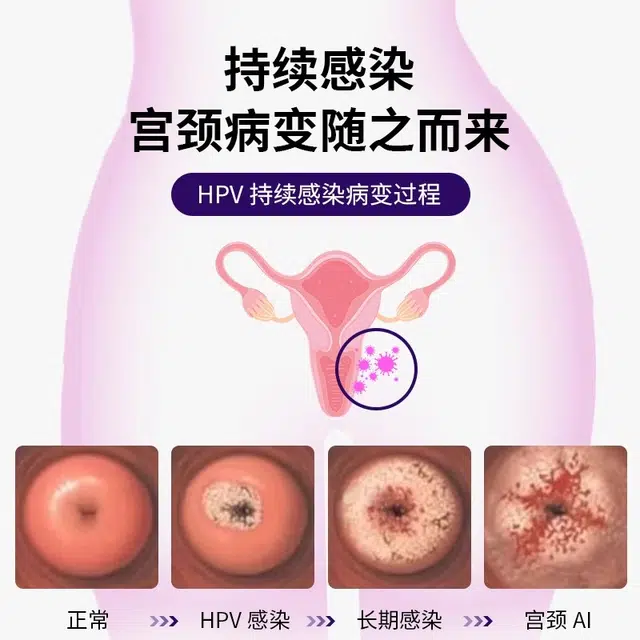 HPV hpv