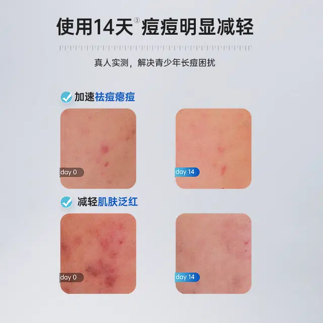 子初 青少年油痘肌精华护肤套装 祛痘舒缓淡痘印保湿滋润清爽补水去角质控油清洁补水滋润型