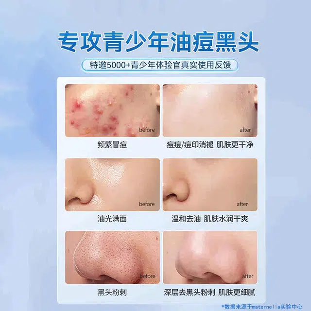 子初 青少年专用水乳洁面泥膜精华油痘肌护肤套装 保湿滋润补水控油清洁