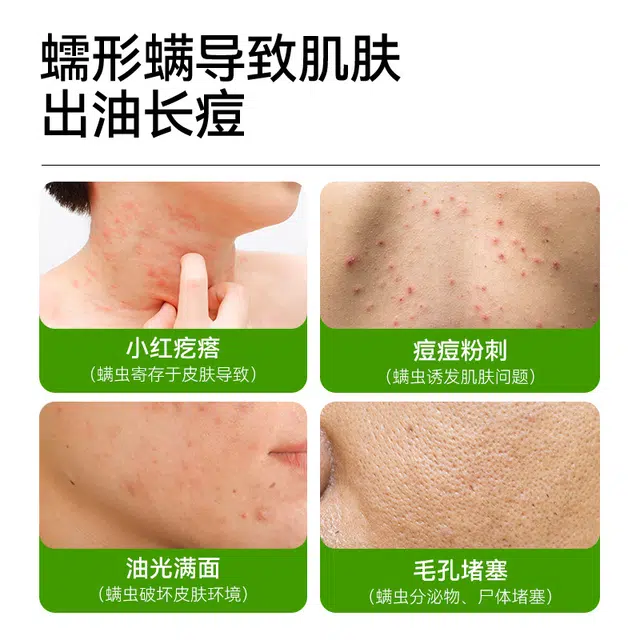满婷 除螨皂 控油祛痘 洗脸洁面皂 深度清洁 非硫磺皂 家庭装 组合装