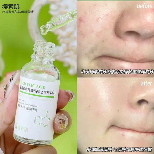 樱素肌水杨酸亮肤祛痘精华液 紧致保湿抗皱