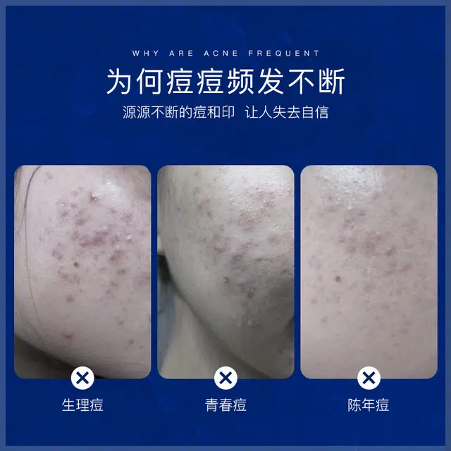 色娜娜  清爽滋润祛痘膏 保湿补水 中性肌