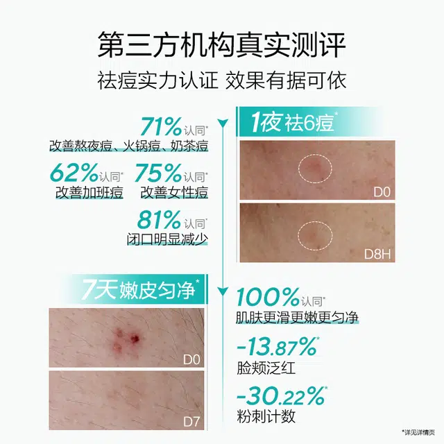 欧诗漫 战痘精华次抛派样装 祛痘保湿控油