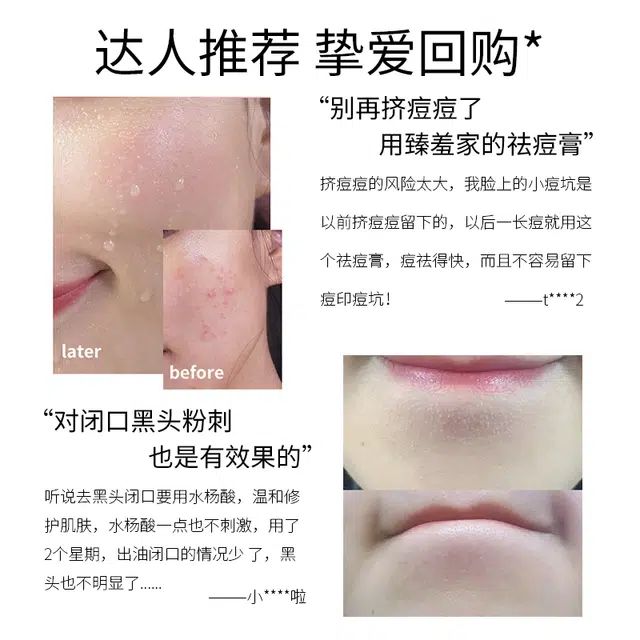 臻羞  水杨酸祛痘膏面霜 膏状 保湿 油皮干皮中性肌