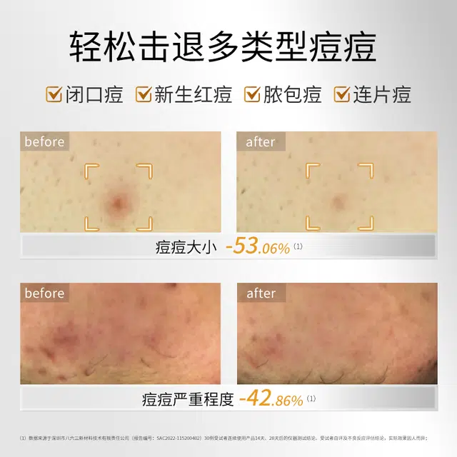 敷尔佳 乳糖酸控油敛肤面膜清痘套组收缩毛孔油痘 保湿祛痘补水