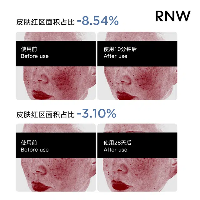 RNW